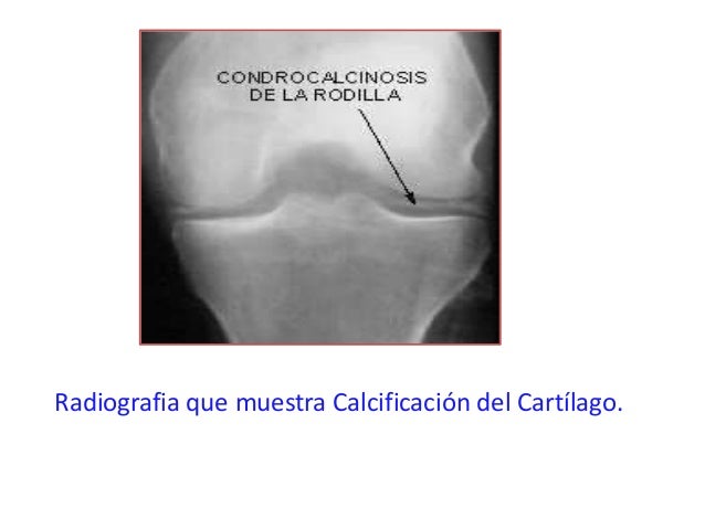 condrocalcinosis pseudogota
